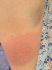 That bruise is from the jabs just hours earlier...thats one brave mosquito!